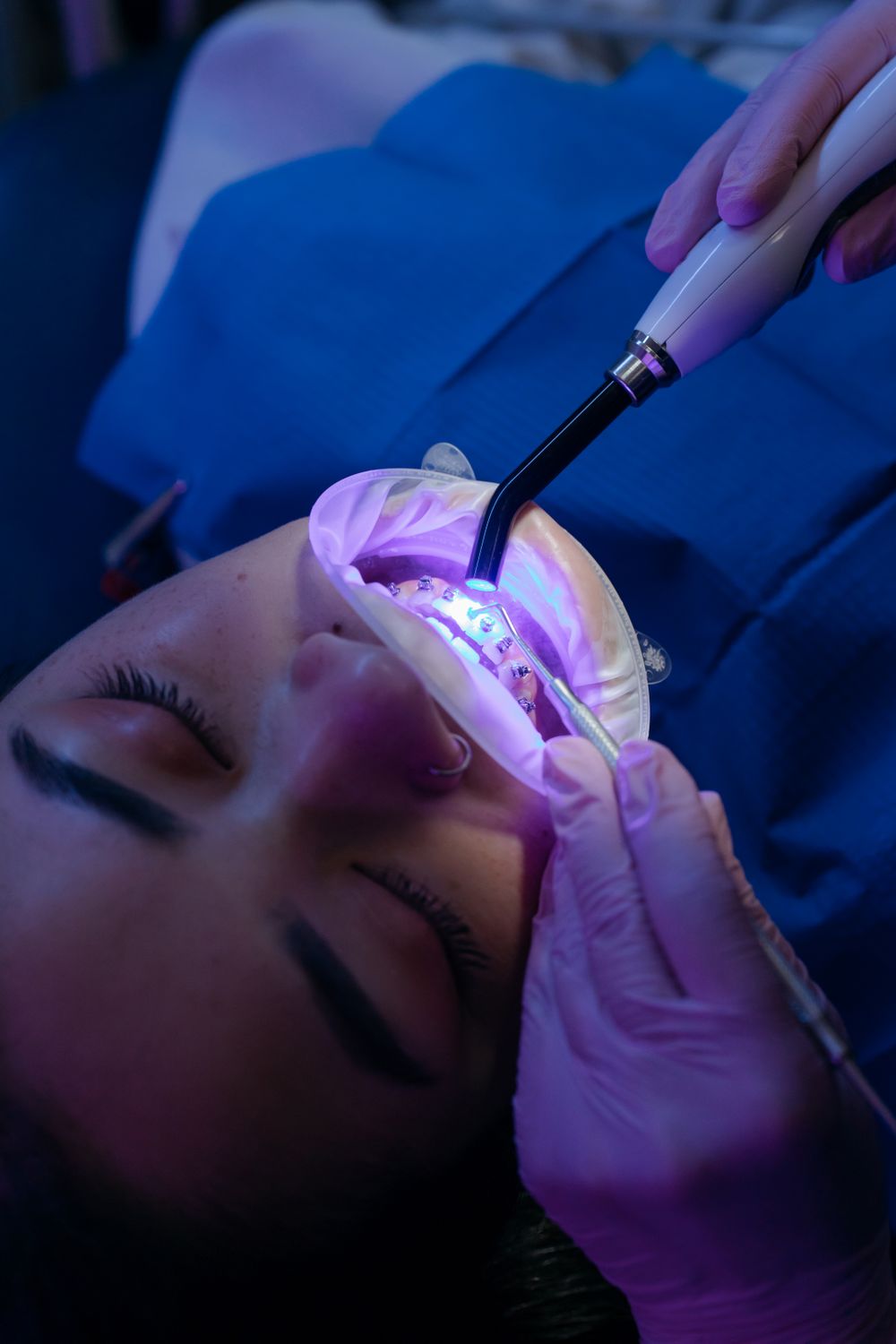 ¿Cuánto dura un blanqueamiento dental?