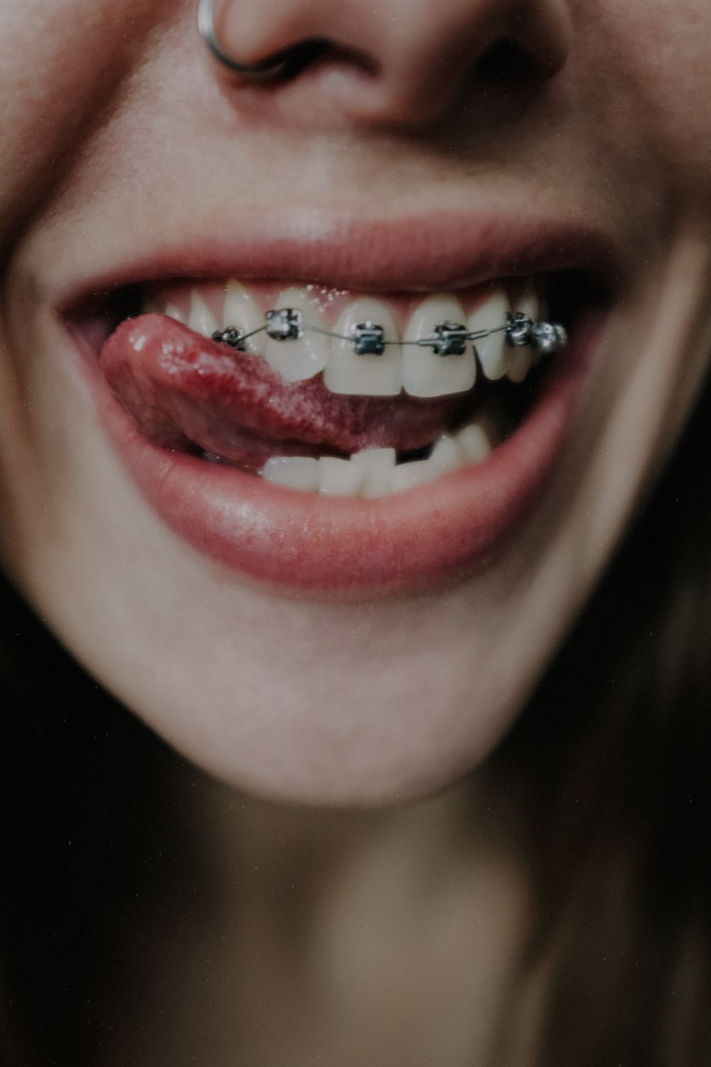 Tipos de brackets: metálicos, cerámicos y de autoligado