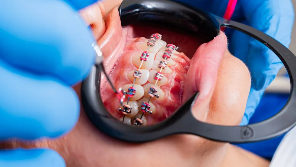 How to care for your braces: hygiene and diet