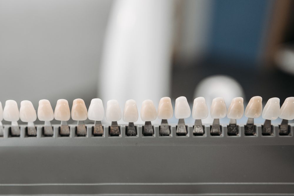 Carillas de porcelana vs. resina: ¿cuál elegir?