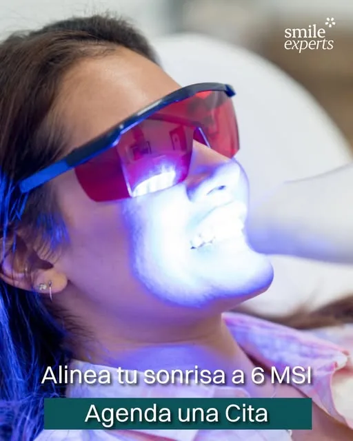 Whitening vs. veneers: what suits me?
