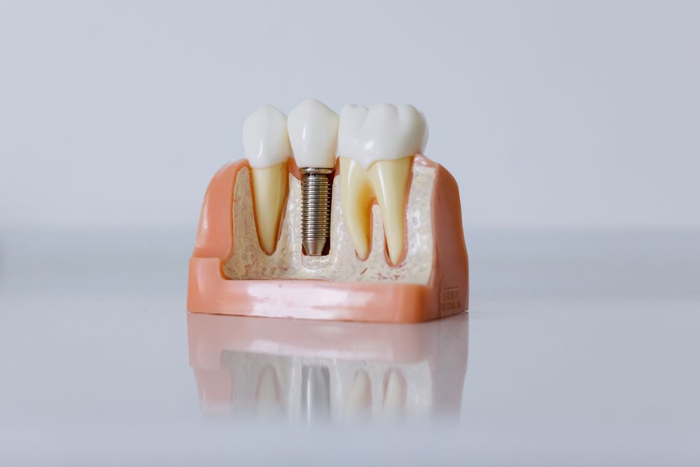 ¿Qué es un implante dental y cómo funciona?