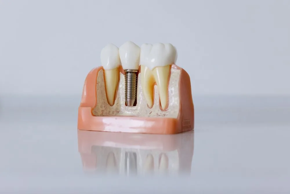 What is a dental implant and how does it work?