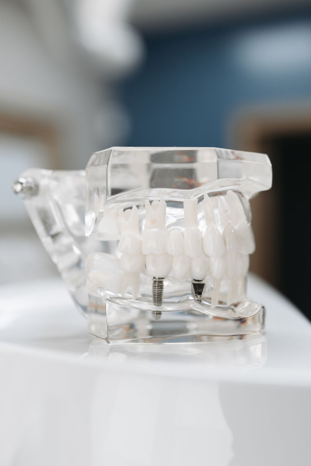Implante dental paso a paso: el proceso completo