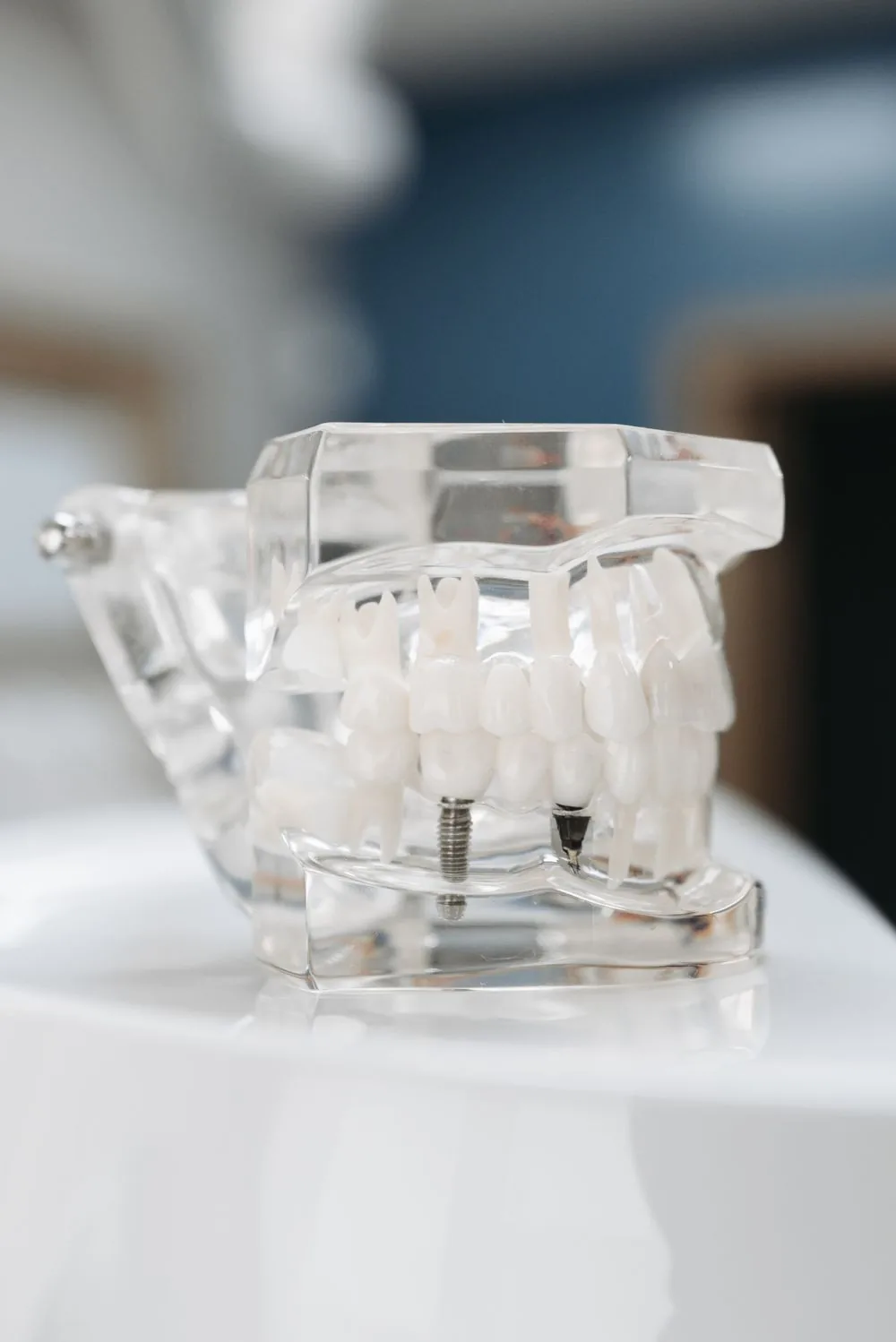 Dental implant step by step: the full process