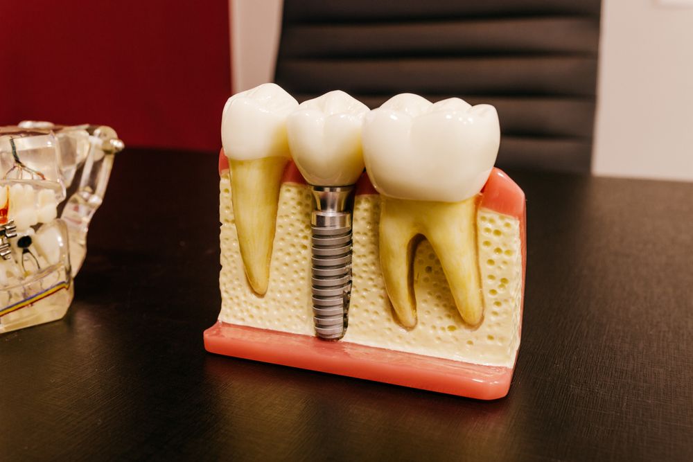 Cuidados después de un implante dental