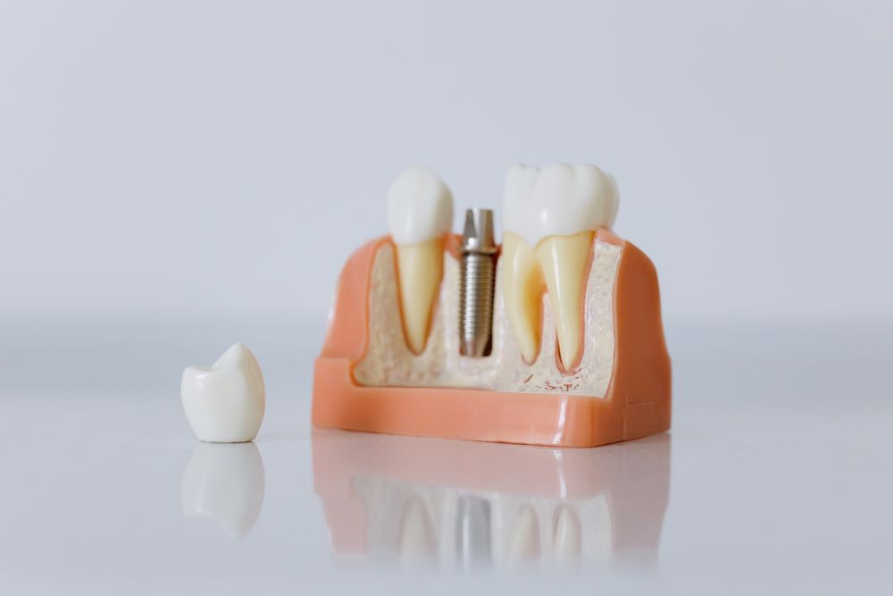 ¿Cuánto dura un implante dental?