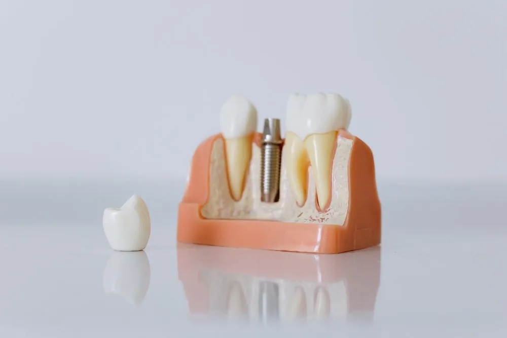 How long does a dental implant last?