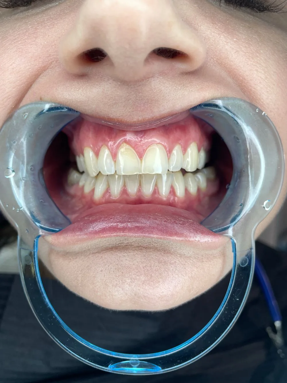 Tartar and plaque: why brushing isn't enough