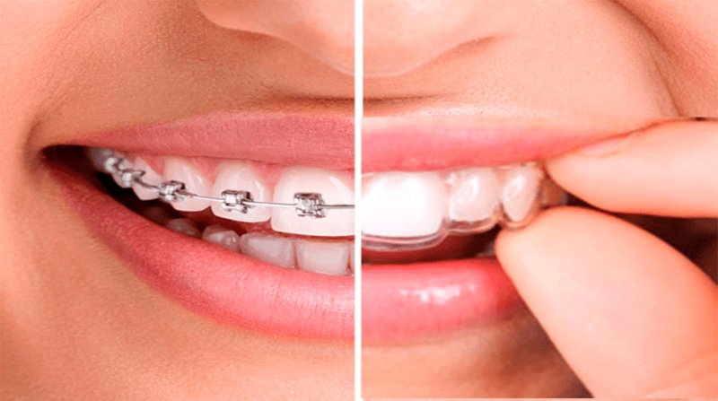 Alineadores invisibles vs. brackets