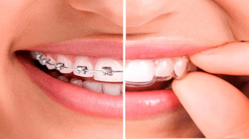 Invisible aligners vs. braces: which to choose?