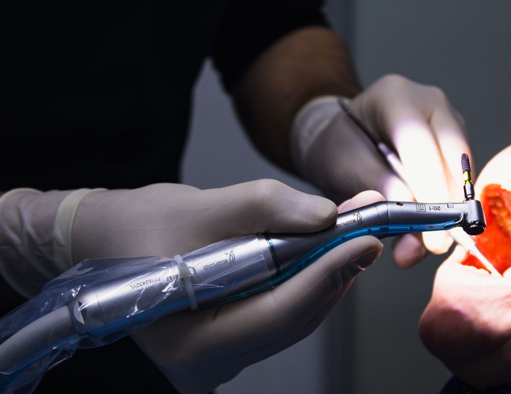 Procedimiento de resina dental de alta estética